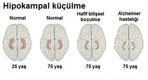 Alzheimer Belirtileri Nelerdir?